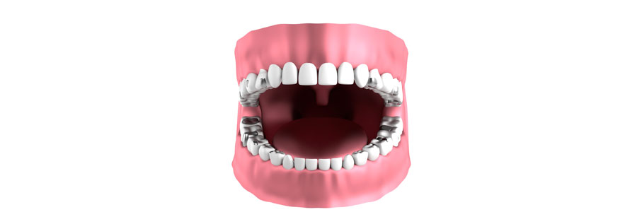 vancouver silver fillings
